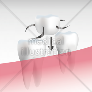 入れ歯のイラスト 無料の医療イラスト素材